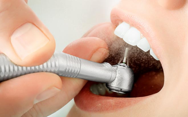 технологии пломбирования зубов